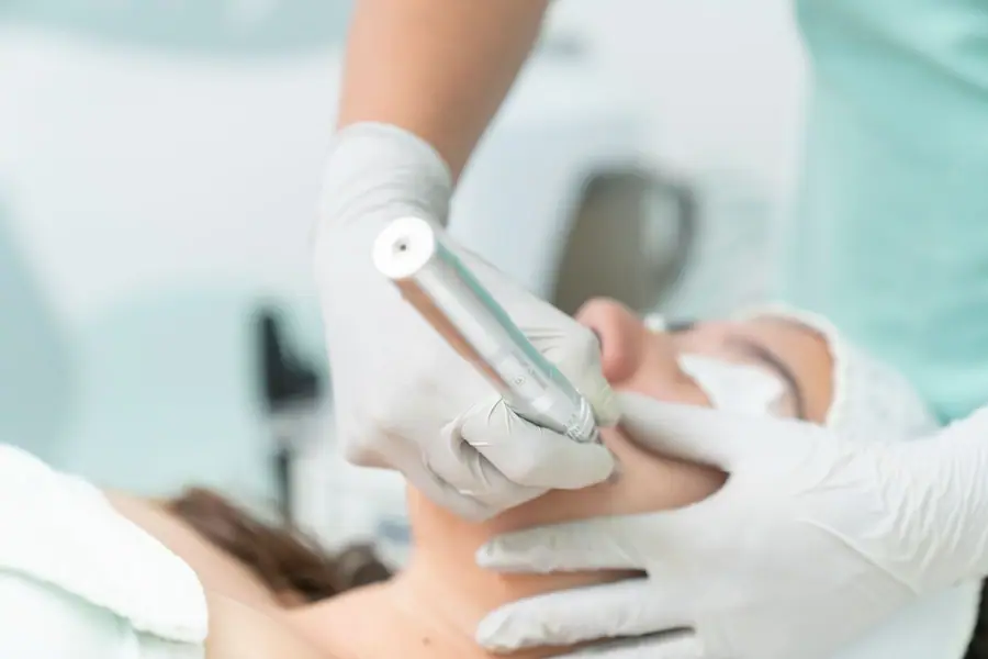 Microneedling with Exosomes