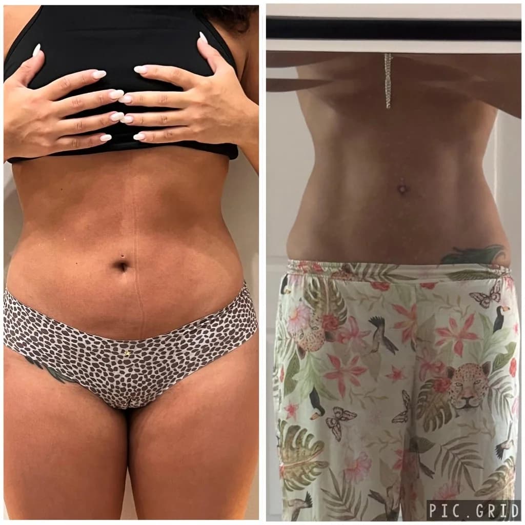 Icoone® Body Contouring before and after