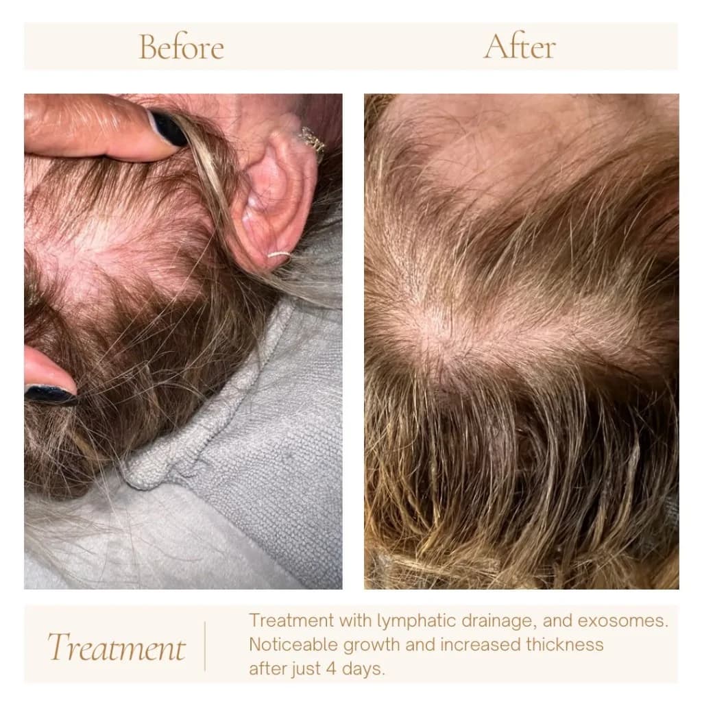 Hair restoration before and after — lymphatic drainage and exosomes